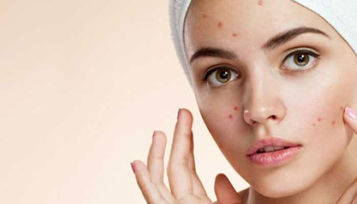 ব্রণ প্রতিরোধের কিছু ঘরোয়া পদ্ধতি