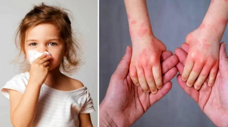 ভারতে নতুন আতঙ্ক ‘টমেটো ফ্লু’, আক্রান্ত শতাধিক