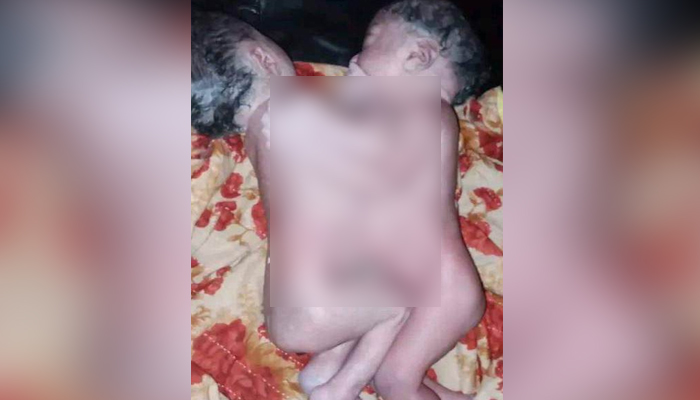বরগুনায় জোড়া লাগানো যমজ শিশুর জন্ম