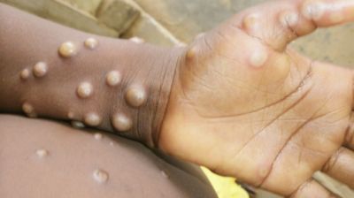 মাঙ্কিপক্স: যেসব লক্ষণে সাবধান হবেন