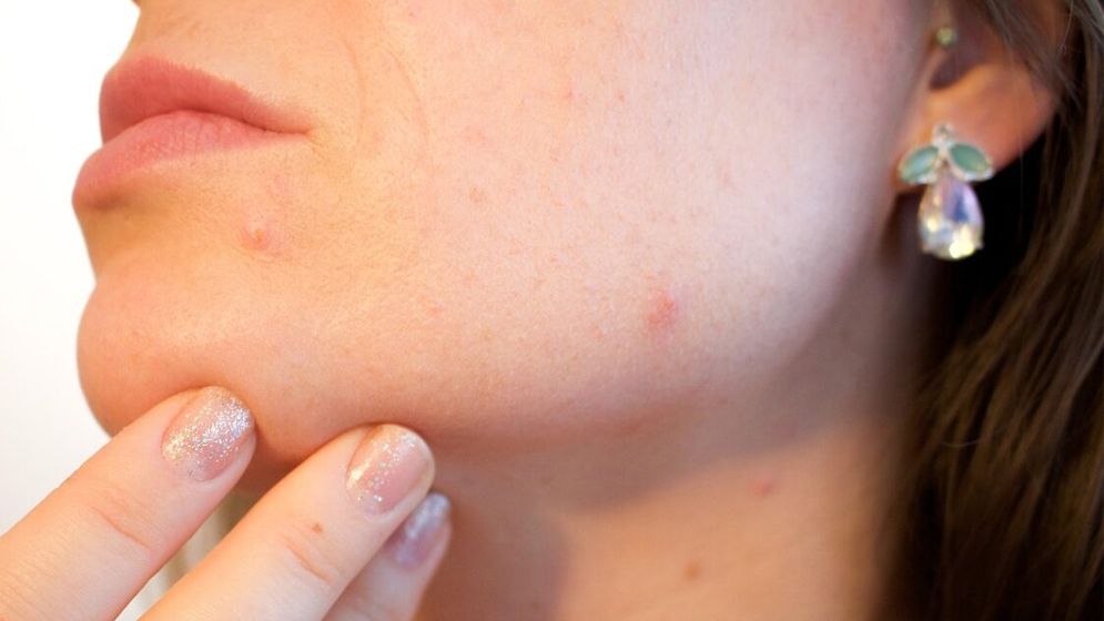 যেভাবে তৈলাক্ত ত্বকের যত্ন নিবেন