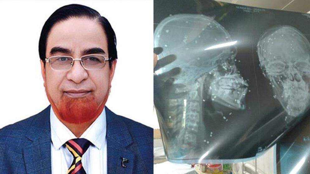 বাহারের নির্দেশে গুলিতে ঝাঁজরা, চোখ হারিয়ে আদালতে মামলা