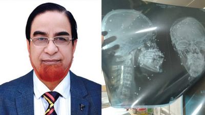 বাহারের নির্দেশে গুলিতে ঝাঁজরা, চোখ হারিয়ে আদালতে মামলা