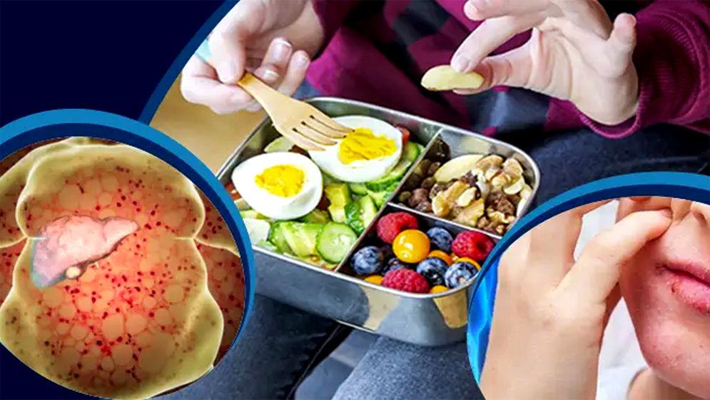 ফ্যাটি লিভার প্রতিরোধে কার্যকর খাদ্যাভ্যাস