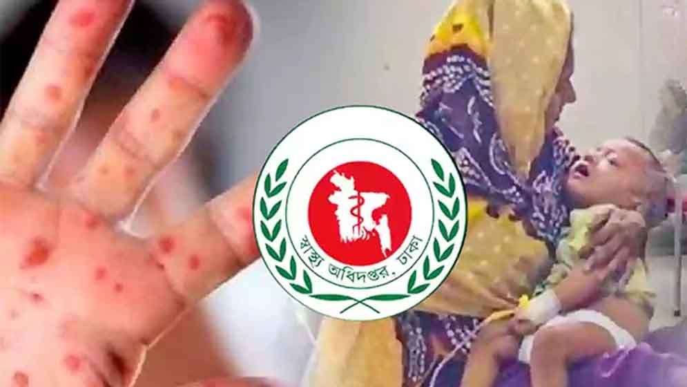 হাম ও উপসর্গে আরও ৫ শিশুর মৃত্যু