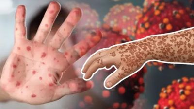 হাম ও উপসর্গে আরও ৫ শিশুর মৃত্যু