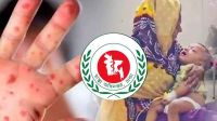 হাম ও উপসর্গে আরও ৫ শিশুর মৃত্যু