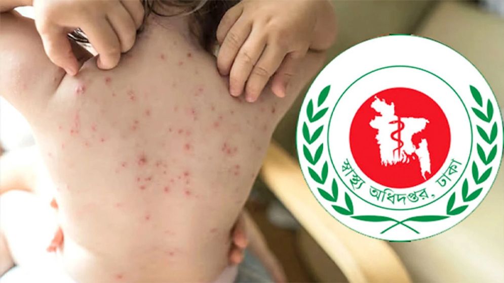 সারাদেশে হাম উপসর্গে আরো ৬ জনের মৃত্যু
